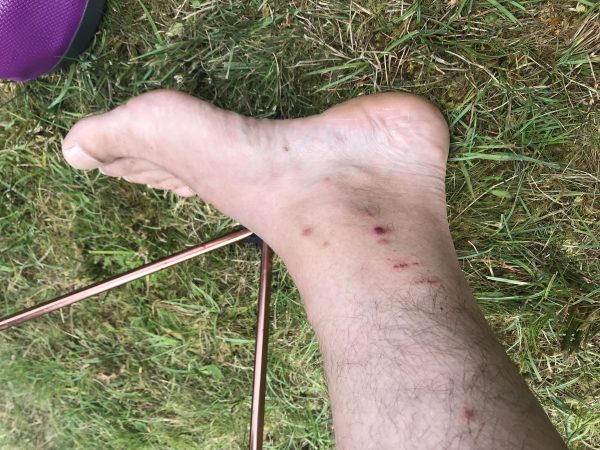 midge bites
